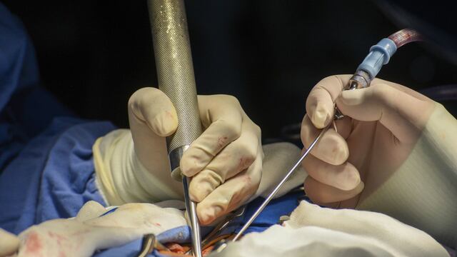 La transposición ileal es una cirugía metabólica que promete controlar la diabetes