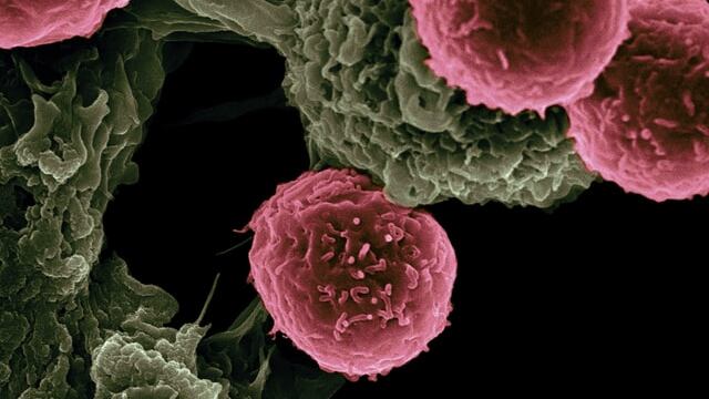 ¿Qué es el sarcoma sinovial?