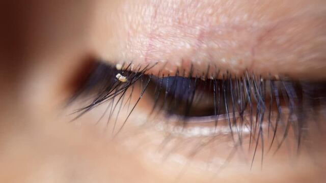 Piojos en las pestañas