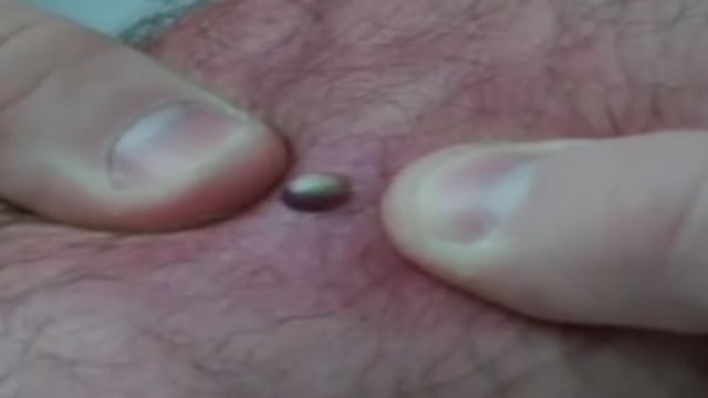Bacteria "come carne" se extiende en Florida