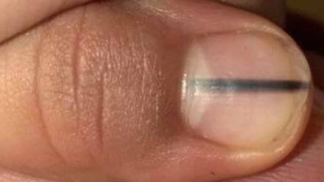 Si notas esto en tus uñas, asiste al doctor.