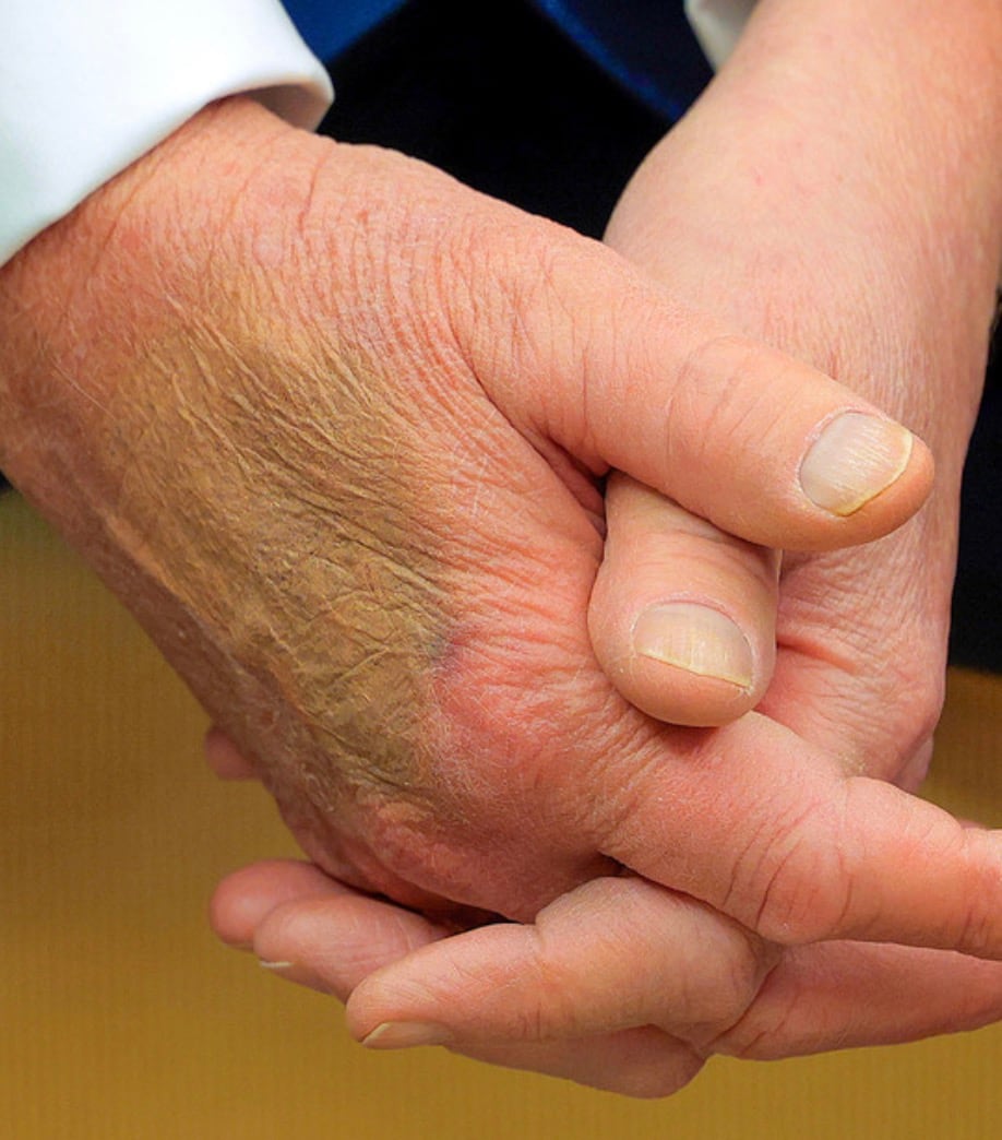 Moretón en mano de Donald Trump