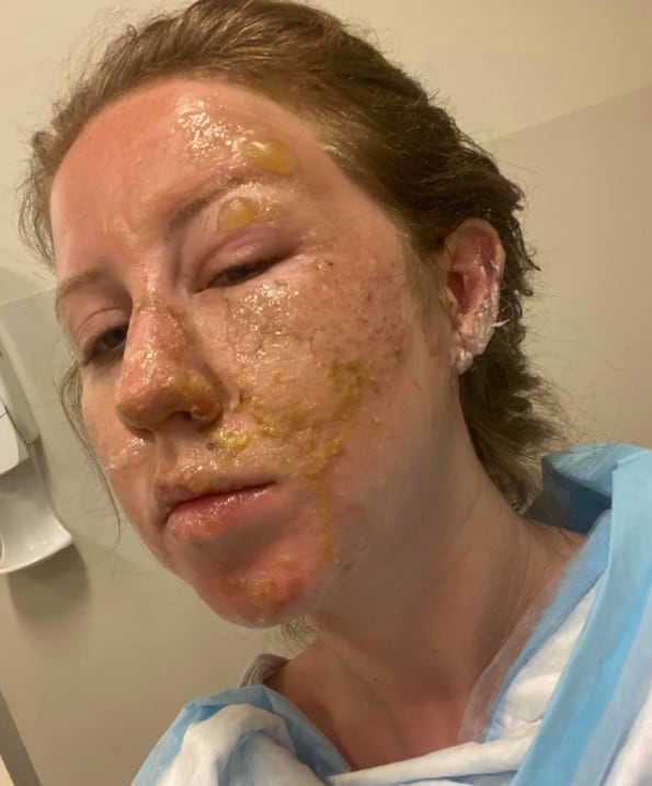 Quemaduras en turista