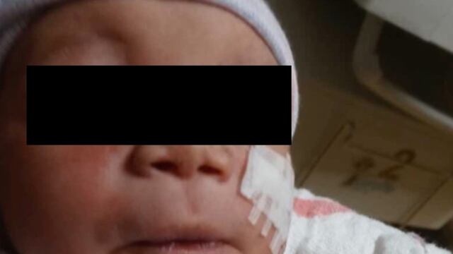 Bebé, su cara fue cortada en una cesárea