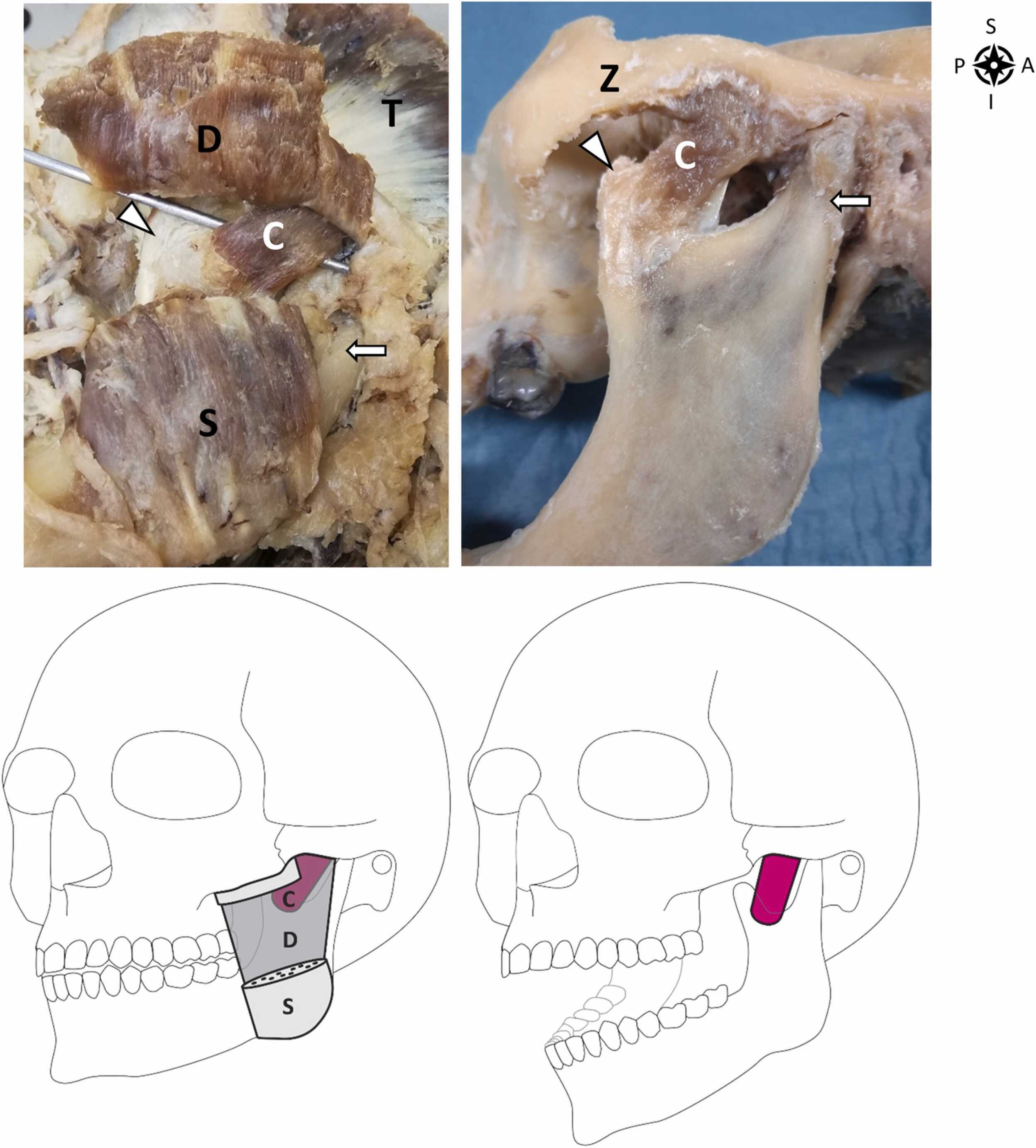 'Musculus masseter pars coronidea'