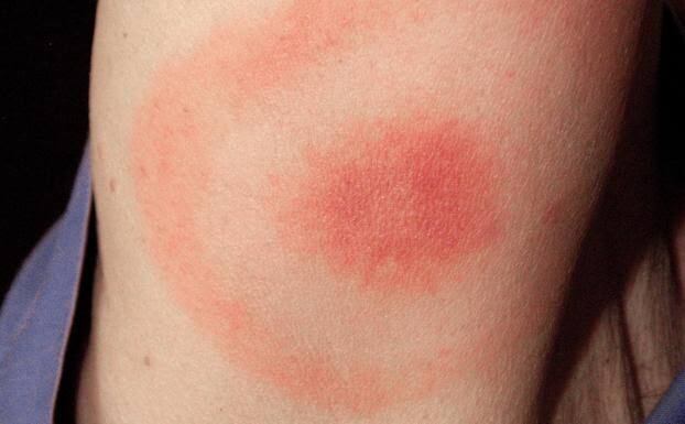 Lyme, primera etapa