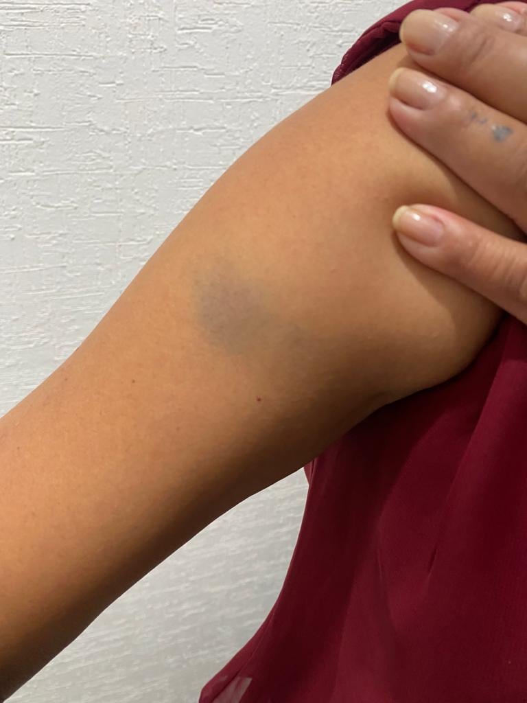 moretones y golpes a la víctima agredida en Querétaro por sus vecino/ @NiUnaMasQroFemi