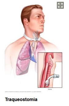 Traqueotomía