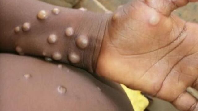 Viruela del mono mpox