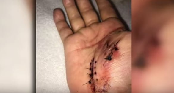 Las terribles consecuencias de la bacteria come carne que casi le arranca la mano.