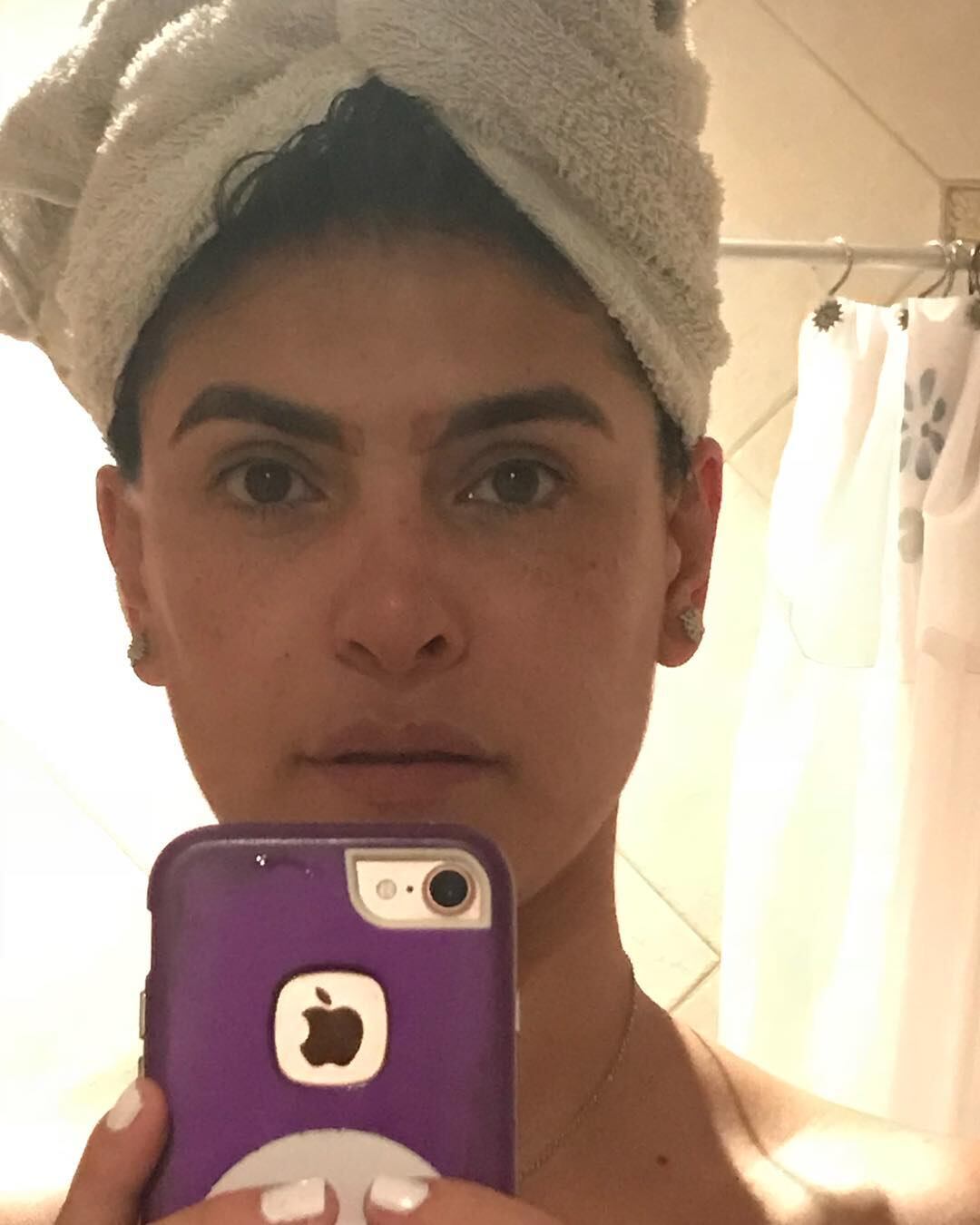 Liz Gallardo mostrando las cicatrices que le dejó un mal microblading.