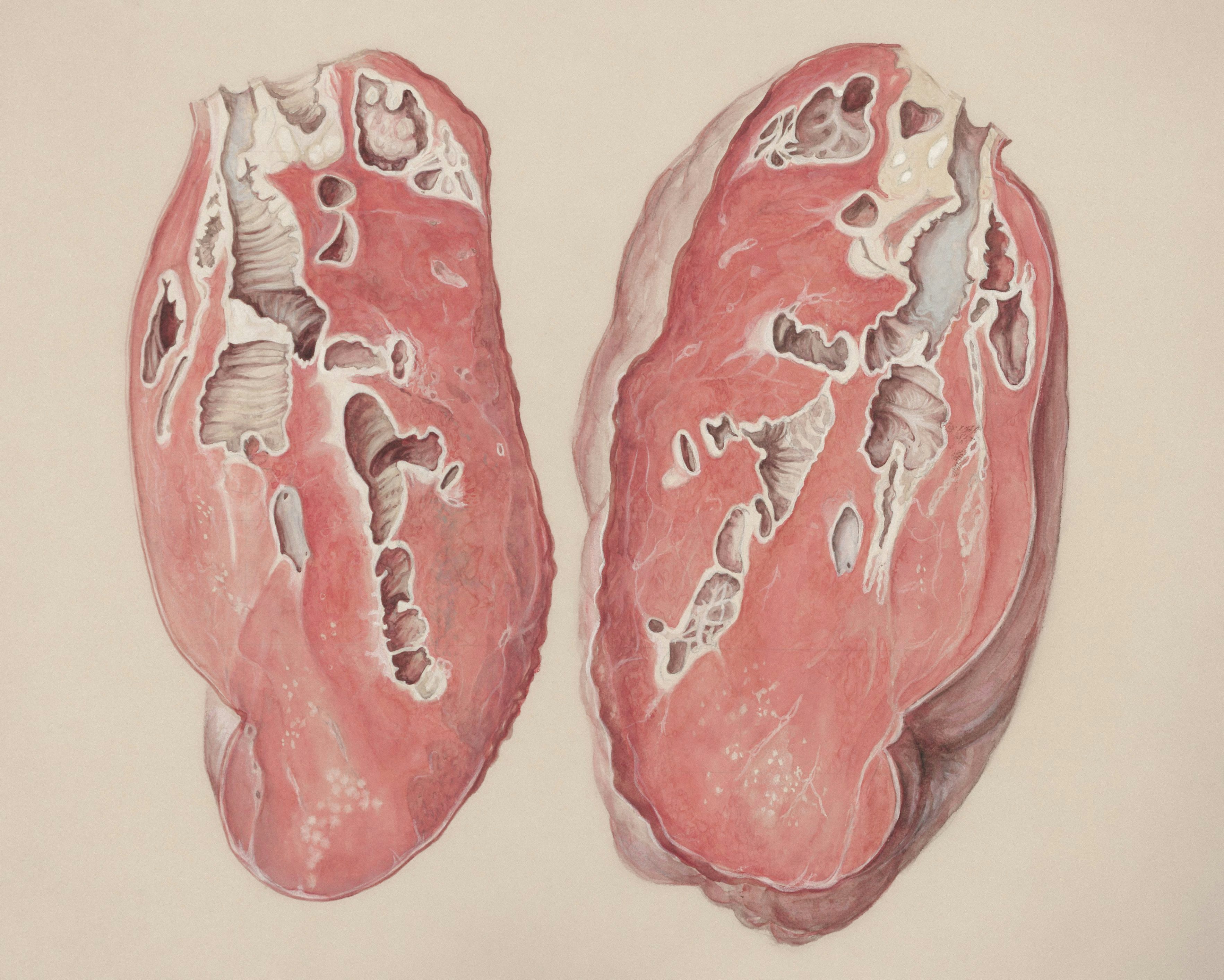 Día Mundial de la Fibrosis Quística