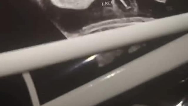 Ultrasonido bebé demonio