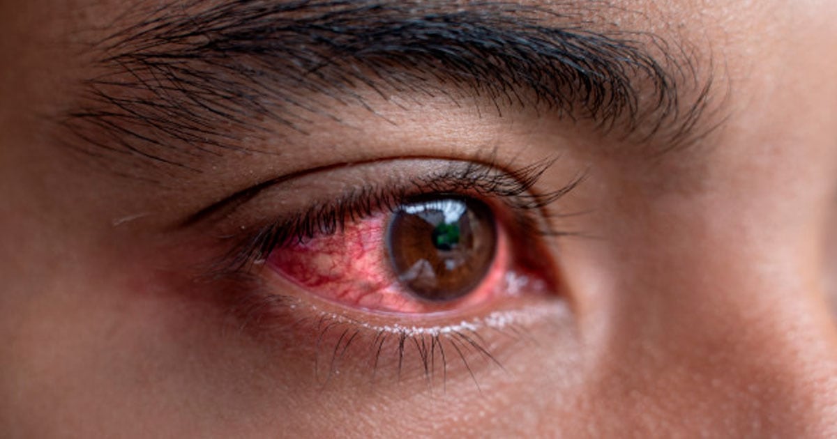 Conjuntivitis por Covid-19
