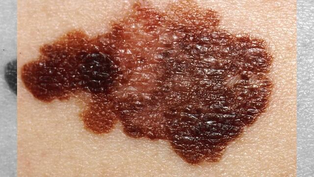 Aunque los ratones que se estudiarion no desarrollaron más tumores de piel que los que habían sido alimentados con antioxidantes, sí desarrollaron el doble de tumores en sus nódulos linfáticos, algo que ocurre cuando hay metástasis.