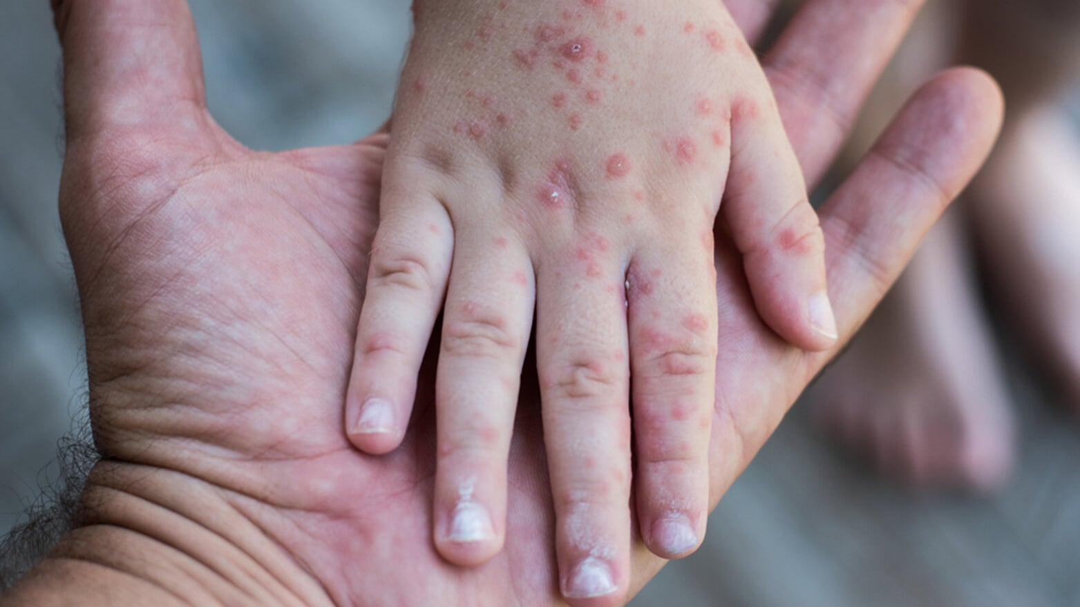 Cómo se contagia el sarampión y cómo evitarlo según la Secretaría de Salud