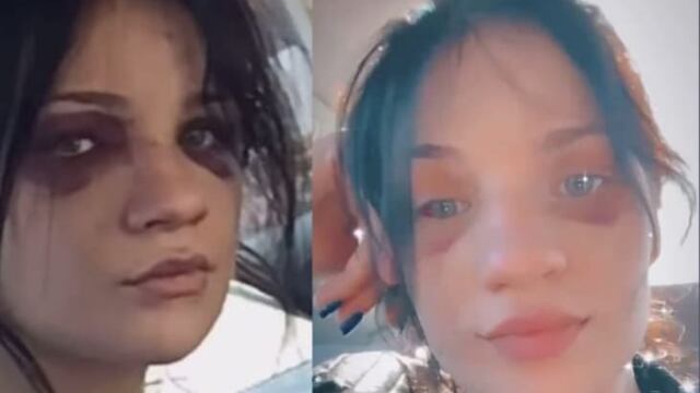 Haley Grace Phillips, la "mujer con "ojos de panda"