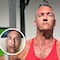 Actor porno revela las lesiones “brutales” que la Viruela del Mono le dejó en el rostro