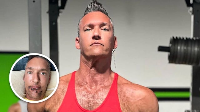 Actor porno con Viruela del Mono