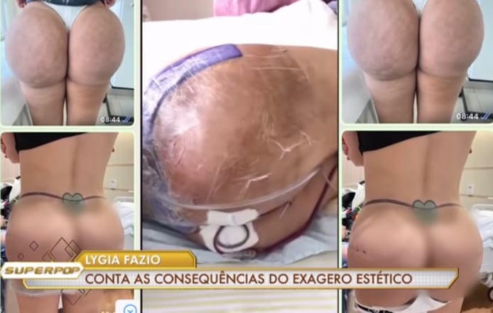 Glúteos de Lygia Fazio tras los polímeros inyectados.