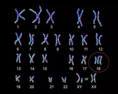 ¿Qué es el Síndrome de Edwards? Esto debes saber de la Trisomía 18