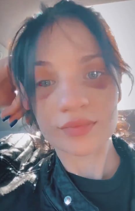 Haley Grace Phillips, la "mujer con ojos de panda"