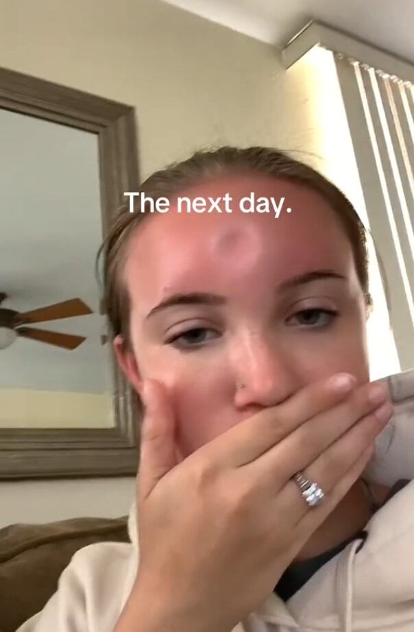 Se le hinchó toda la frente después de tomar el Sol y muestra en TikTok cómo le quedó