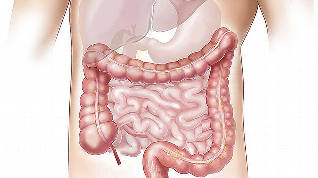 Reducen la edad para realizar estudios preventivos del cáncer de colon