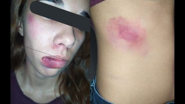 Golpes recibidos en intento de secuestro.