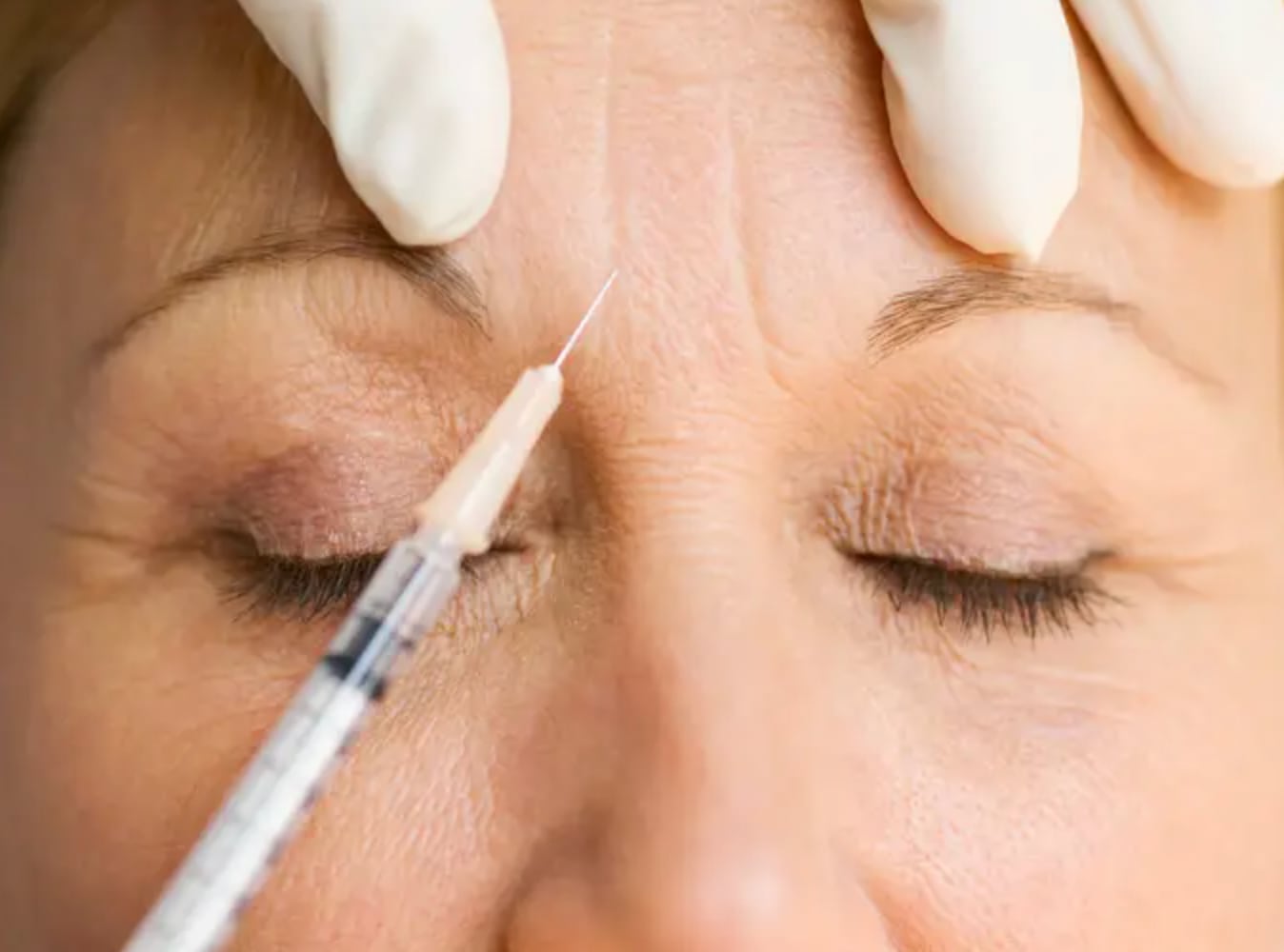 Inyecciones de bótox