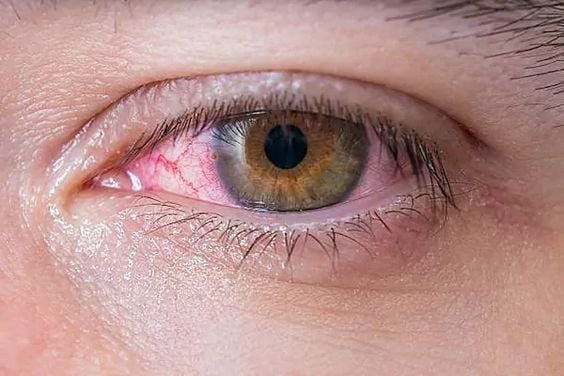 Conjuntivitis por Covid-19