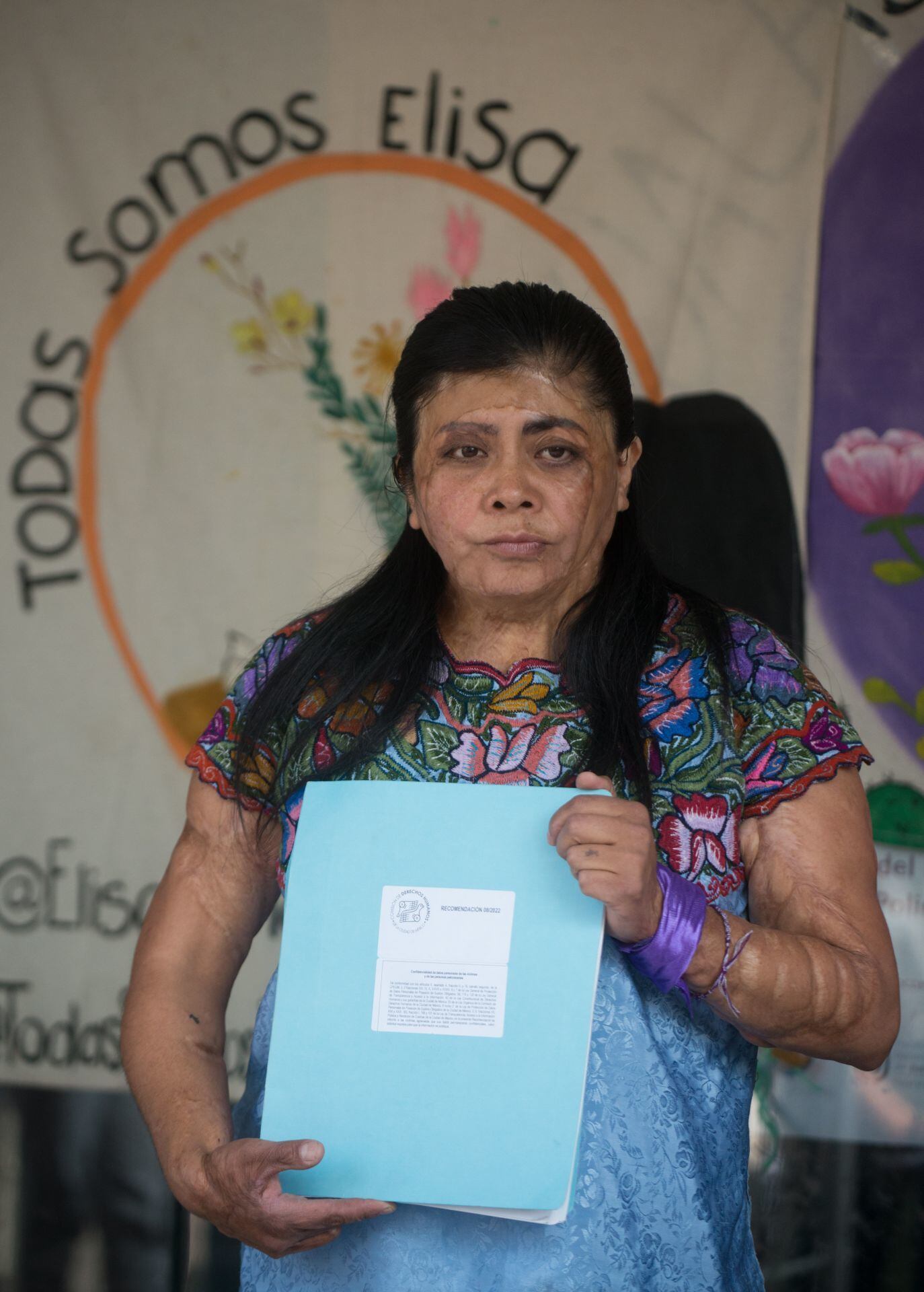 Elisa Xolalpa, víctima de tentativa de feminicidio por un ataque con ácido