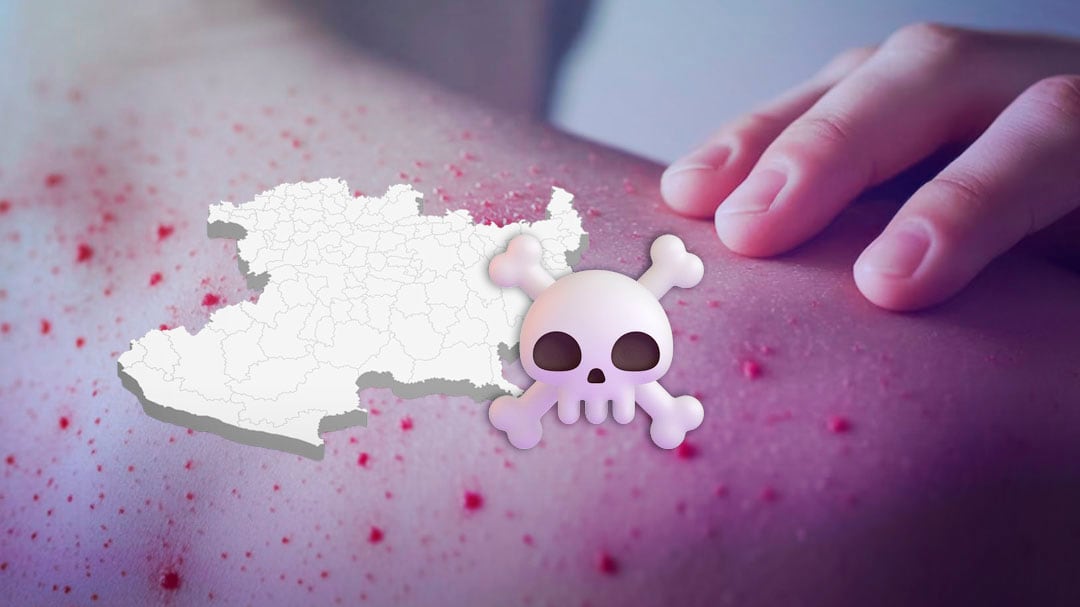 Michoacán reporta la primera muerte por sarampión del año