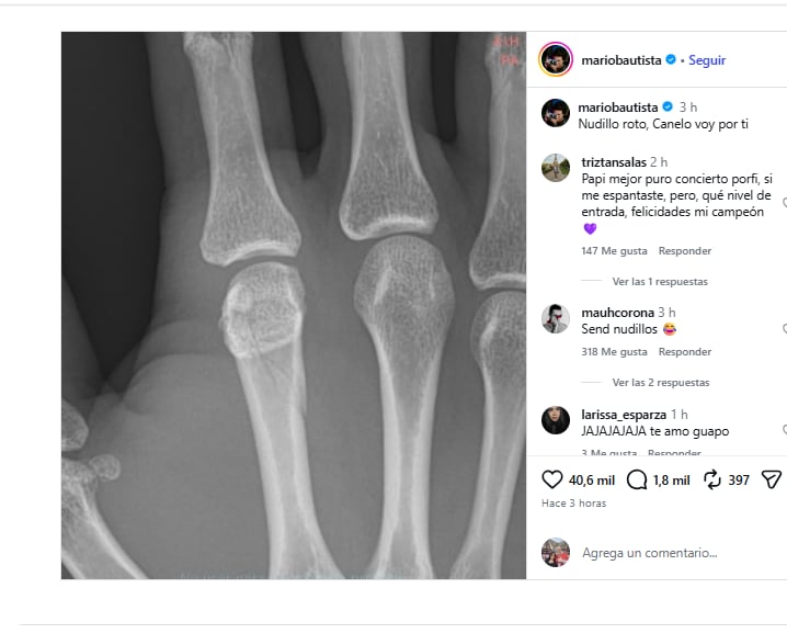 Fractura de Mario Bautista