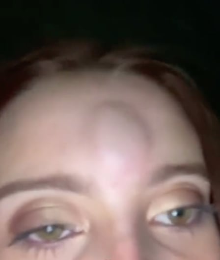 Peda termina mal hasta con chichón incluido