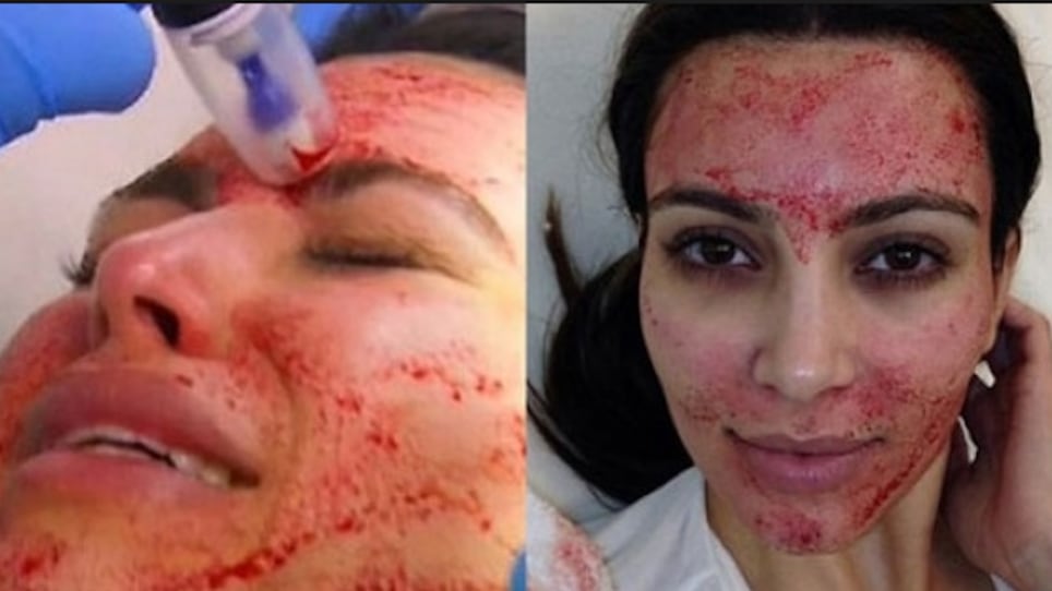 Facial de vampiro.