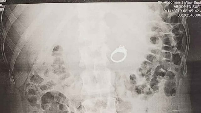 Una mujer se tragó su anillo de compromiso mientras tenía una pesadilla.