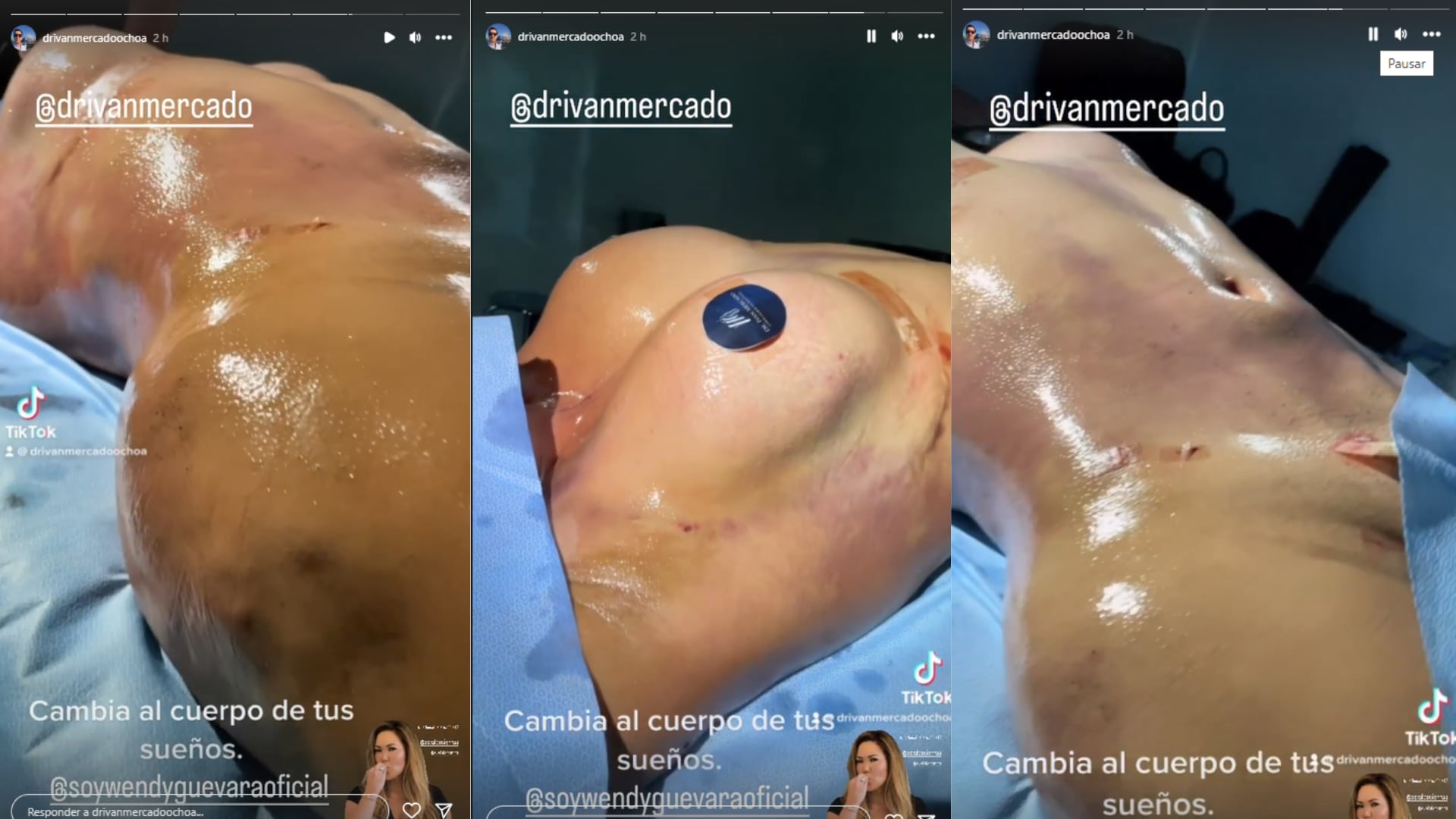 Así quedó Wendy Guevara tras su nueva cirugía estética.