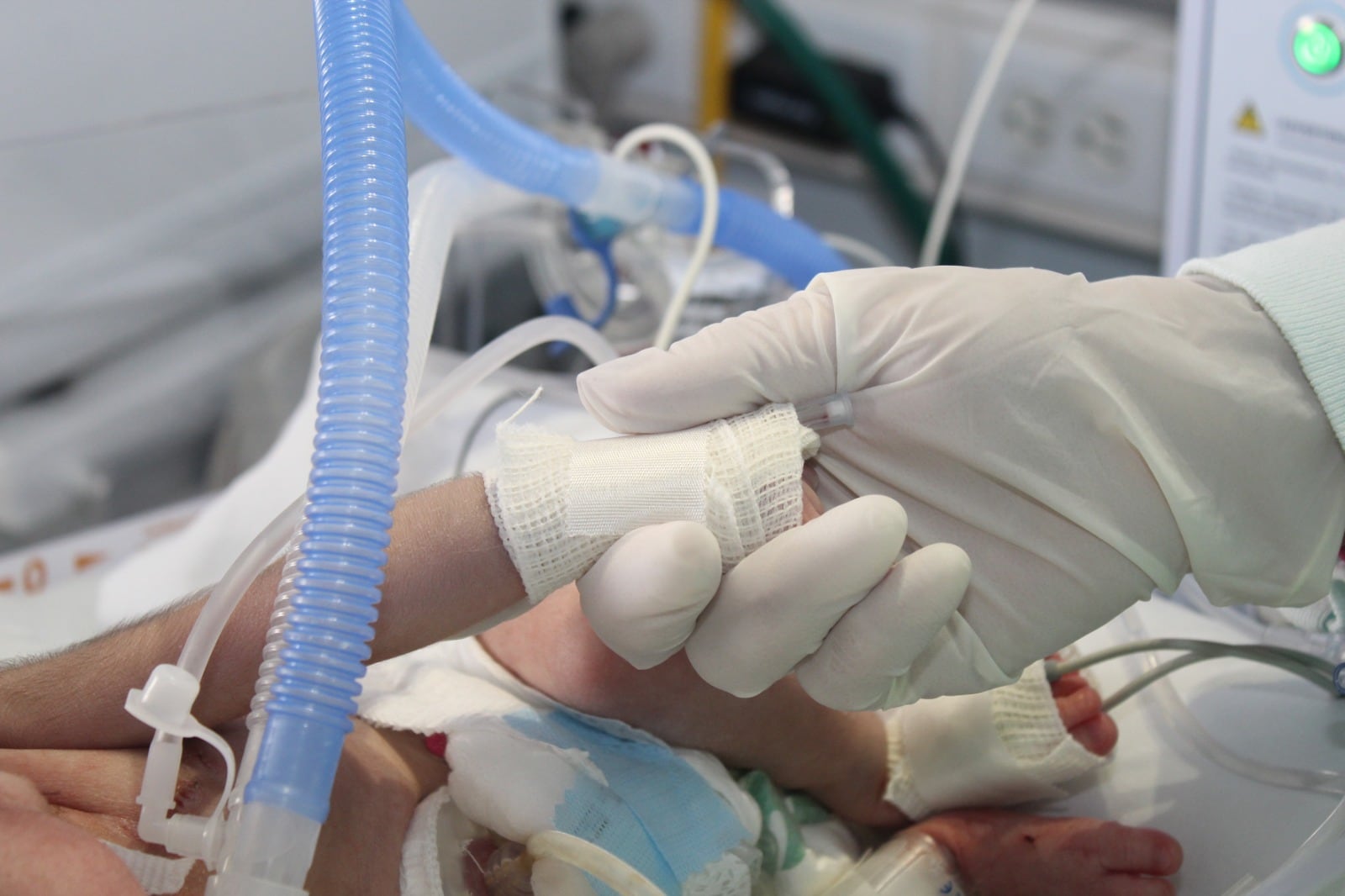 IMSS retiran tumor de 20 centímetros