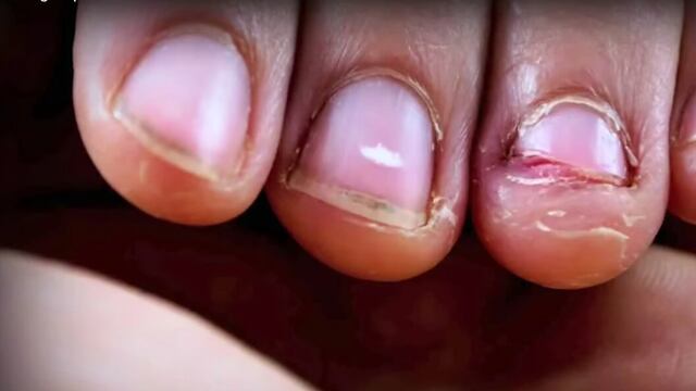 Grave infección casi lo mata por morderse las uñas