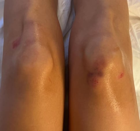 Así quedaron las rodillas de Belinda tras su caída en París Fashion Week 2024