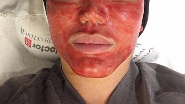 Un tratamiento bastante sangriento.