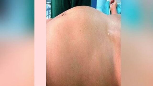 Vivió con el feto de su gemelo en el abdomen durante 17 años