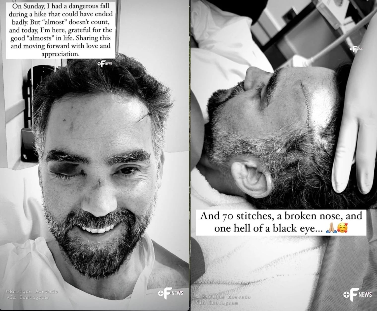 Enrique Acevedo sufrió una lesión en el ojo tras una caída