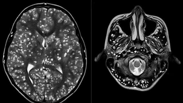 Cerebro de un joven de 18 años.