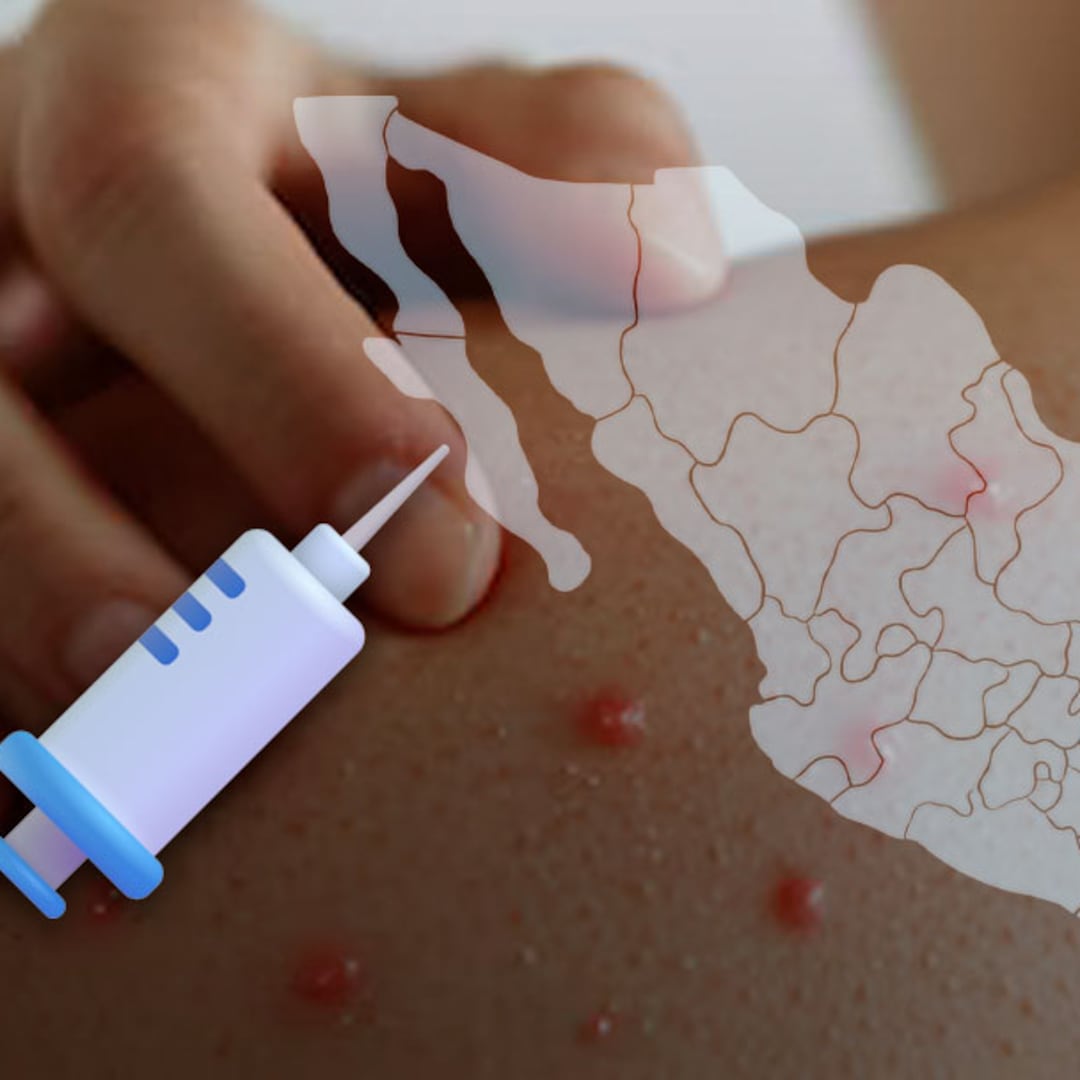 Secretaría de Salud reporta descenso de contagios de sarampión tras caso mortal en Jalisco