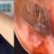 Va al doctor por un dolor de oído y descubre que tiene una araña viva dentro (VIDEO)