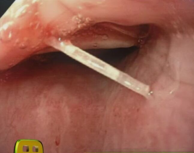 Linet Puente se atragantó con una espina de pescado