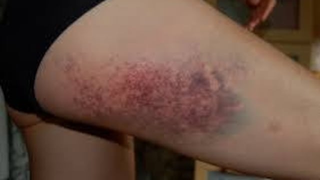 Equimosis violáceas