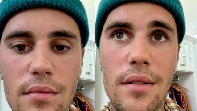 Justin Bieber sufre parálisis facial